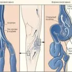 Разширените вени домашно лечение, народни средства