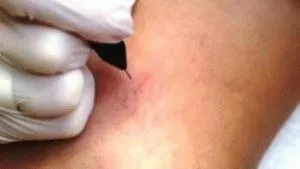 Разширените кулумни причини и лечения