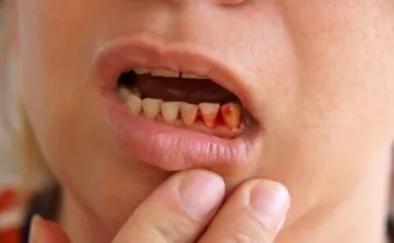 Възпаление на венците са възпалени и какво да правят и как да се отнасяме