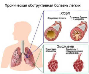 Хронична обструктивна белодробна болест - какво е това