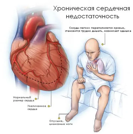 Хронични симптоми и лечение на сърдечна недостатъчност