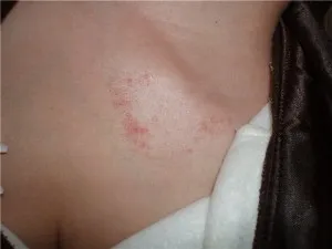 Парцел за лечение на псориазис, който помага да се отървем от тази болест (парцел) Парцелът за лечение на псориазис, който помага да се отървете от тази болест