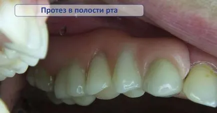 Протезите kvadrotti (Quattro ти) - пристрастяване
