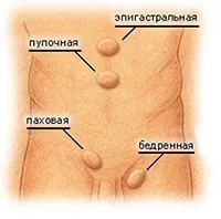 Какво е херния