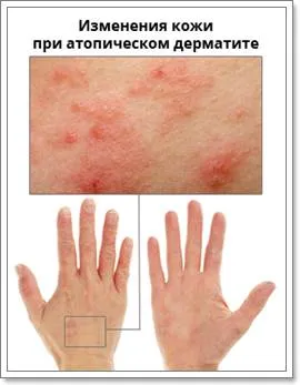 Какво е атопичен дерматит и как да се лекува симптомите и лечение, хранене, видео