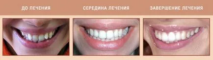 Какво е скоба върху зъбите как да се сложи, колко са скоби преди и след инсталацията