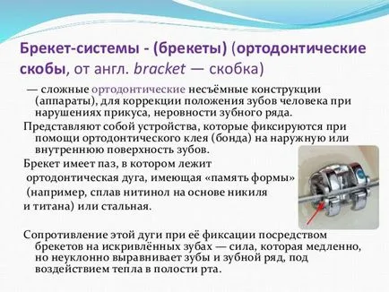 Какво е скоба върху зъбите как да се сложи, колко са скоби преди и след инсталацията