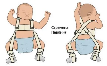 Хип дисплазия при деца
