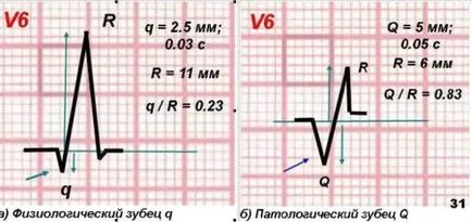 ЕКГ дете