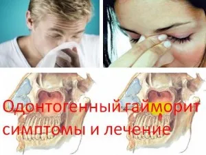 Odontogén arcüreggyulladás tünetei és kezelése, a boszorkány doktor