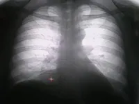 Működés a tüdőben a tuberkulózis, a tüdő sebészi eltávolítása, thoracoplasty