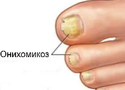 Onychomycosis - причини, симптоми и народната медицина лечение на онихомикоза