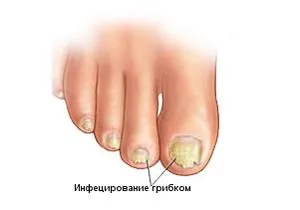 Onychomycosis - причини, симптоми и народната медицина лечение на онихомикоза