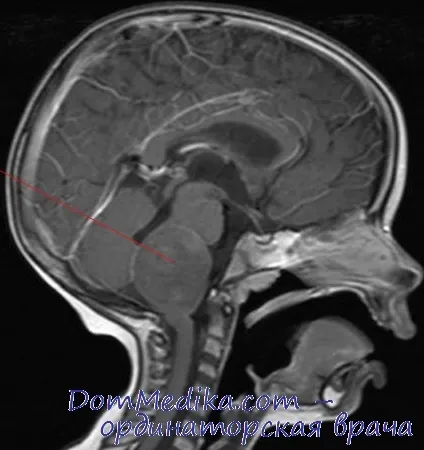 Тумор на мозъчния ствол при дете причинява, диагностика, лечение