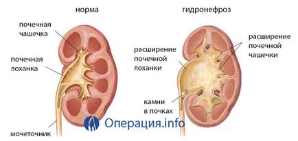 Операция в хидронефроза - основно лечение