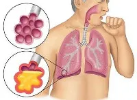 pneumonie acuta - cauze, simptome, diagnostic și tratament