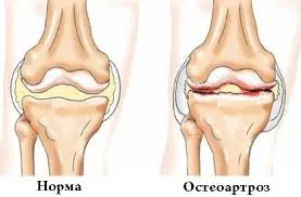 Osteoartrita a genunchiului 2 grade