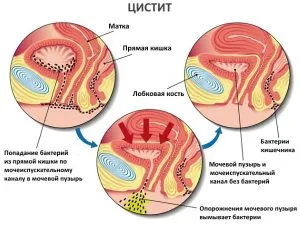 Остри симптоми и лечение на жени с цистит