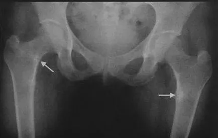 Osteomalacia - csontlágyulás