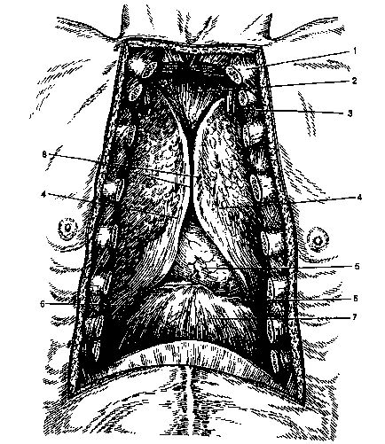 akut mediastinitis