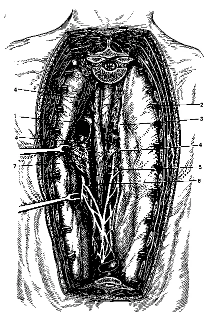 mediastinita acută