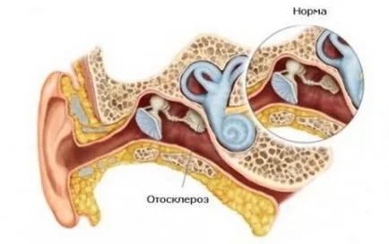 Otosclerosis - tünetek és kezelés