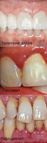 A periodontitis tünetei, okai és következményei