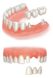 A periodontitis - Sebészeti, orvosi, ortopédiai paradentózisnál és egyéb