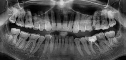 A periodontitis - Sebészeti, orvosi, ortopédiai paradentózisnál és egyéb