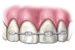 Parodontita și periodontita care este diferența