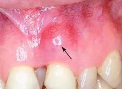 A periodontitis modern kezelési módszerek, paradentózisnál modern fogászat