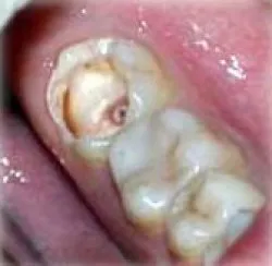 A periodontitis modern kezelési módszerek, paradentózisnál modern fogászat