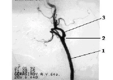 Periorbital Doppler anterograd fluxului sanguin în artera corespunde direcției supratrochlear