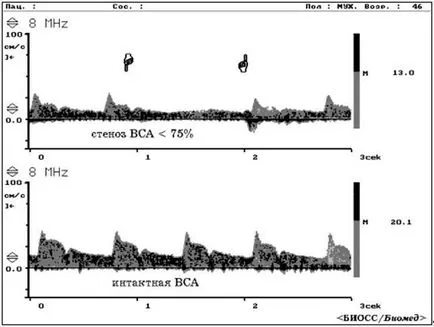 Periorbitális Doppler antegrád véráramlást az artéria irányának felel meg supratrochlear