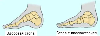 Плоски крака при децата, лекувани как да разпознават и лечение на плоски стъпала