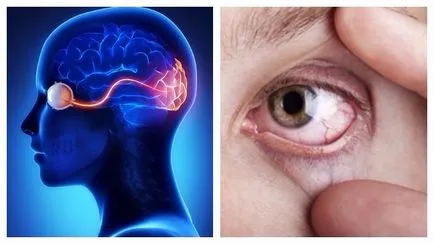 Miért van fájdalom a szem mozgása során a szemgolyó