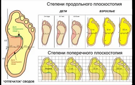 Simptome și tratament plate, longitudinale, transversale 1, 2, 3 grade, branț ortopedice cu