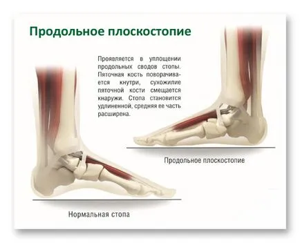 Симптоми и лечение плосък, надлъжно, напречно 1, 2, 3 градуса, ортопедични стелки с