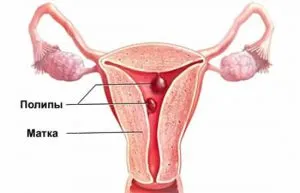 polip cervical in timpul sarcinii simptome, diagnostic și tratament