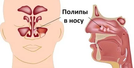 Orrpolip tünetei, kezelési és eltávolítási felnőttek és gyermekek