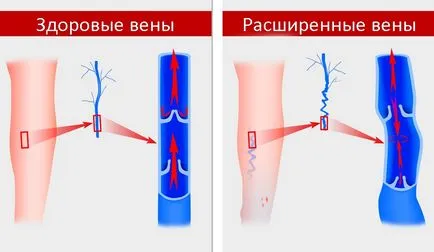 Полезно е да дали да предприеме аспирин с разширени вени и как да го направя