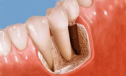 Costul integral al implanturilor dentare