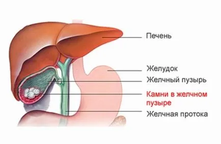 Диария след отстраняване на жлъчния мехур (холецистектомия) третиране