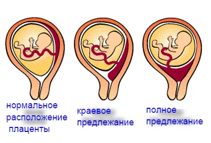 Плацента превия причинява симптомите, опасности и лечение по време на бременността, раждането