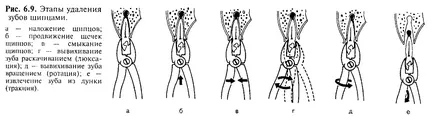 Методи за отстраняване на форцепс зъбите - добра дентална портал, добра дентална портал