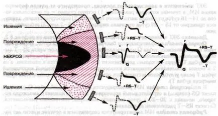 Semne si simptome de infarct miocardic la bărbați și femei