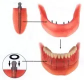 implant protetic, stomatologie centrală