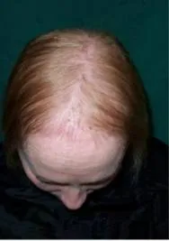 Profilaxia tratamentul alopeciei