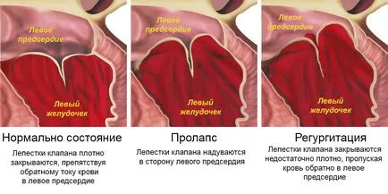 Пролапс на митралната клапа симптоми, лечение и профилактика