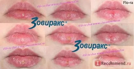 agenți antivirali farmaceutice GlaxoSmithKline SA Zovirax - „herpes labial